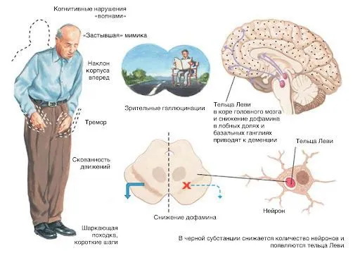 Симптомы сосудистой деменции