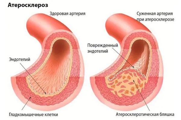 Атеросклеротическая бляшка